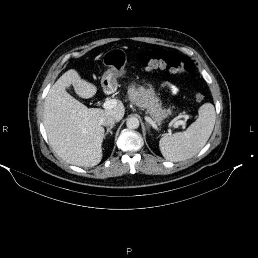 File:Acute pancreatitis (Radiopaedia 85390-101010 Axial C+ portal venous phase 28).jpg