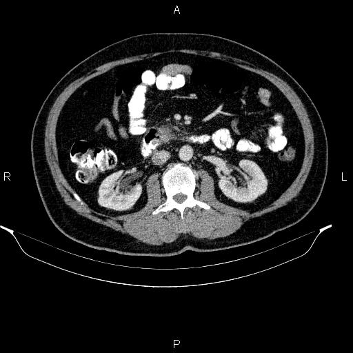 Acute pancreatitis (Radiopaedia 85390-101010 Axial C+ portal venous phase 49).jpg
