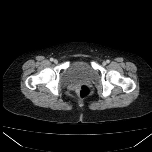 Acute pancreatitis - Balthazar C (Radiopaedia 26569-26714 Axial C+ portal venous phase 93).jpg
