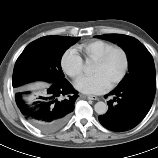 Acute pancreatitis and walled-off necrosis (Radiopaedia 29888-30403 Axial C+ delayed 4).jpg