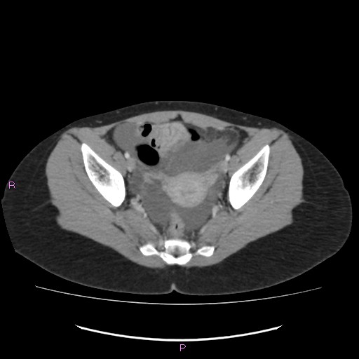 File:Acute pancreatitis secondary to stone at minor papilla and pancreatic divisum (Radiopaedia 76570-88333 Axial C+ portal venous phase 68).jpg