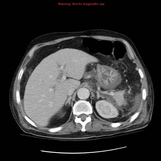 File:Acute pancreatitis with incidental pancreatic lipoma (Radiopaedia 10190-10730 Axial C+ portal venous phase 16).jpg