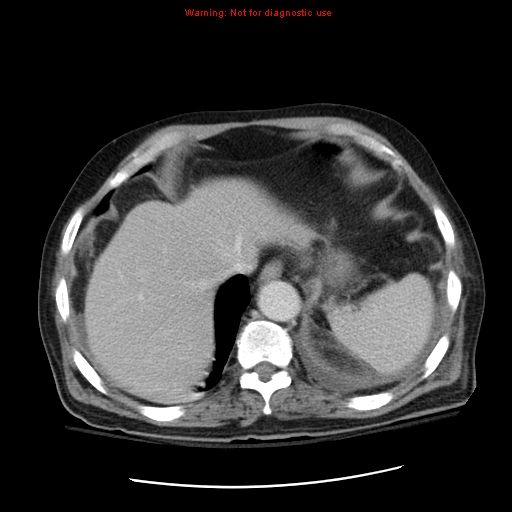 File:Acute pancreatitis with incidental pancreatic lipoma (Radiopaedia 10190-10730 Axial C+ portal venous phase 9).jpg