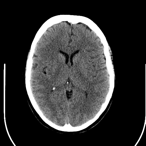 File:Acute pontine infarct from vertebral artery dissection (Radiopaedia 34111-35369 Axial non-contrast 15).png