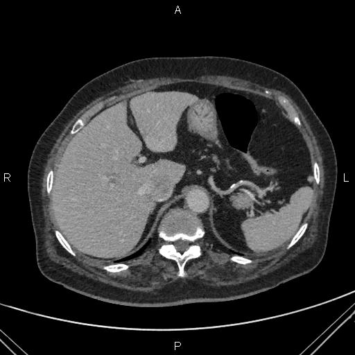 File:Acute renal artery occlusion (Radiopaedia 86586-102682 Axial C+ portal venous phase 13).jpg