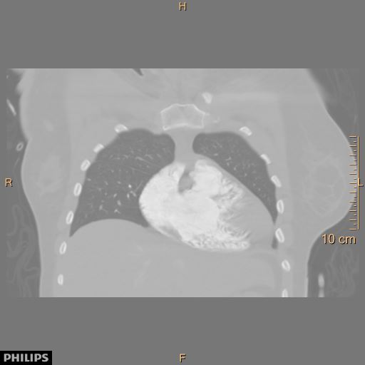 File:Acute reversible pulmonary hypertension and right heart failure from cocaine toxicity (Radiopaedia 49394-54517 Coronal 11).jpg