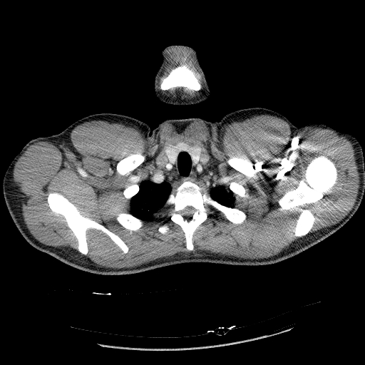 Acute segmental pulmonary emboli and pulmonary infarction (Radiopaedia 62264-70444 Axial C+ CTPA 13).jpg