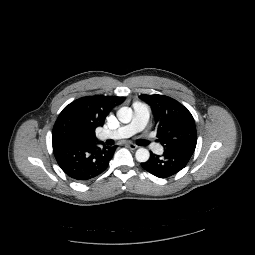 Acute segmental pulmonary emboli and pulmonary infarction (Radiopaedia 62264-70444 Axial C+ CTPA 51).jpg