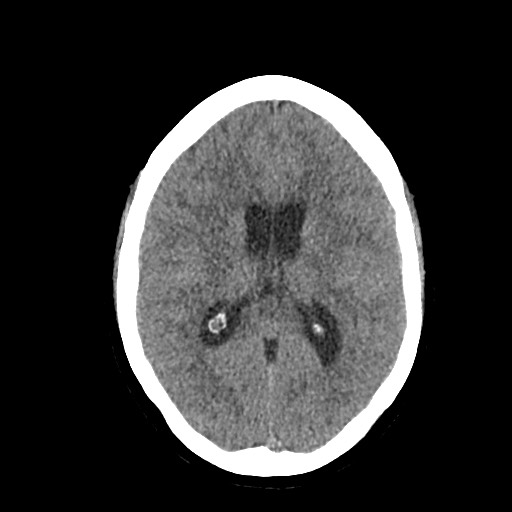 File:Acute subarachnoid hemorrhage and accessory anterior cerebral artery (Radiopaedia 69231-79008 Axial non-contrast 30).jpg