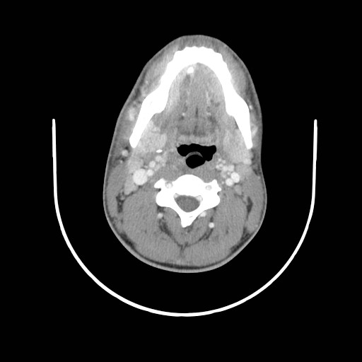 File:Acute submandibular sialadenitis secondary to ductal stone (Radiopaedia 27999-28267 Axial C+ delayed 22).jpg