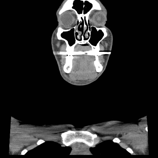 File:Acute submandibular sialadenitis secondary to ductal stone (Radiopaedia 27999-28267 Coronal C+ delayed 16).jpg