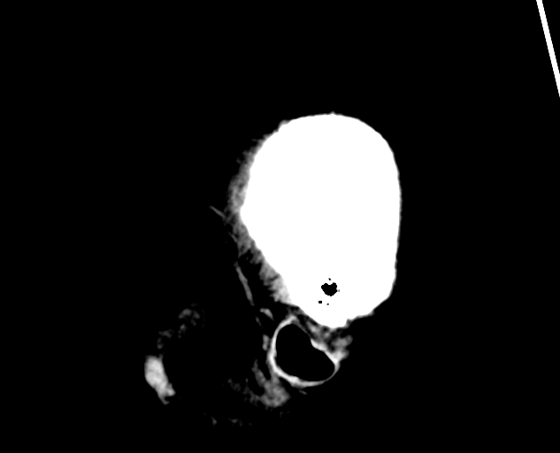 Acute traumatic subdural hematoma (Radiopaedia 82921-97257 Sagittal non-contrast 10).jpg
