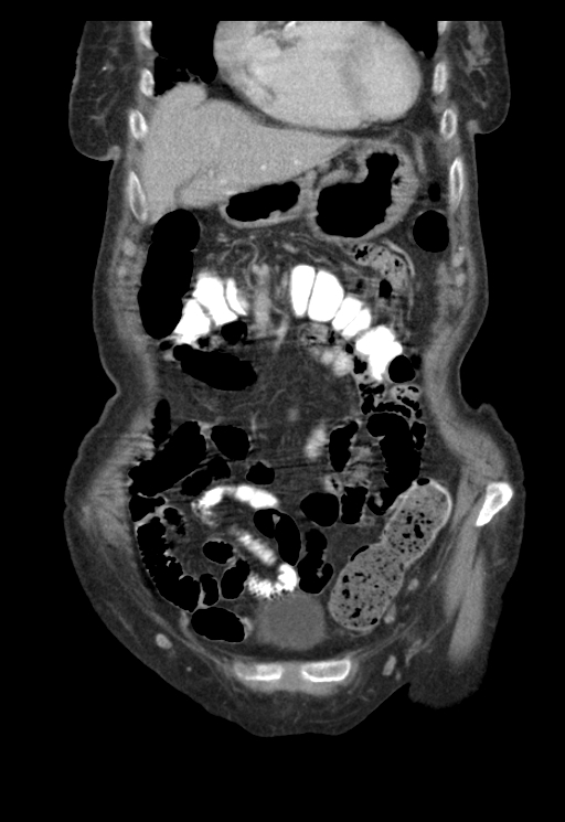 Adenocarcinoma of cecum (Radiopaedia 59222-66549 Coronal C+ portal venous phase 12).jpg