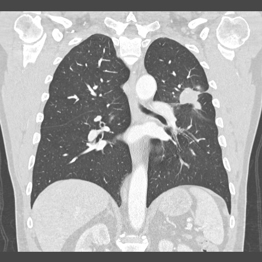Adenocarcinoma of the lung (Radiopaedia 59871-67325 Coronal lung window 37).jpg