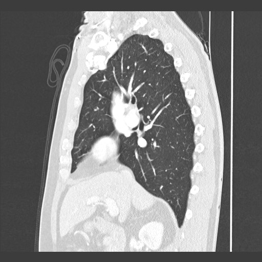 Adenocarcinoma of the lung (Radiopaedia 59871-67325 Sagittal lung window 38).jpg