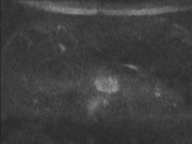 Adenocarcioma of rectum- T1 lesion (Radiopaedia 36921-38546 Axial DWI 69).png