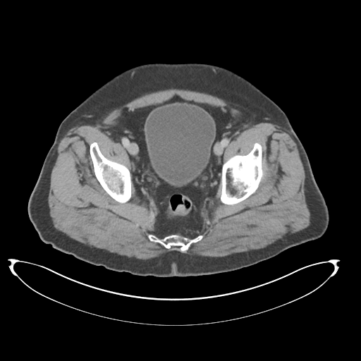 Adenocarcioma of rectum- T1 lesion (Radiopaedia 36921-38547 Axial C+ portal venous phase 78).png