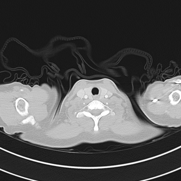 File:Adenocystic carcinoma of the trachea (Radiopaedia 47677-52525 Axial lung window 25).jpg
