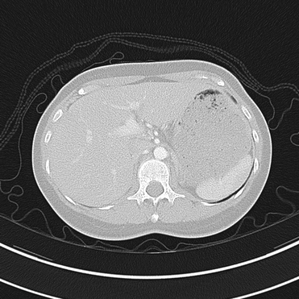 Adenocystic carcinoma of the trachea (Radiopaedia 47677-52525 Axial lung window 78).jpg