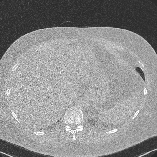 Adenoid cystic carcinoma of the trachea (Radiopaedia 49042-54137 Axial lung window 311).jpg