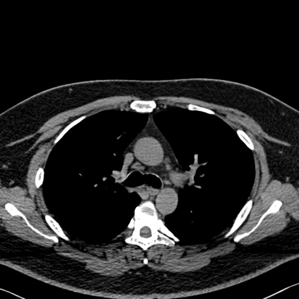 Adenoid cystic carcinoma of the trachea (Radiopaedia 49042-54137 Axial non-contrast 122).jpg