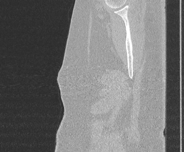 Adenoid cystic carcinoma of the trachea (Radiopaedia 49042-54137 Sagittal lung window 9).jpg