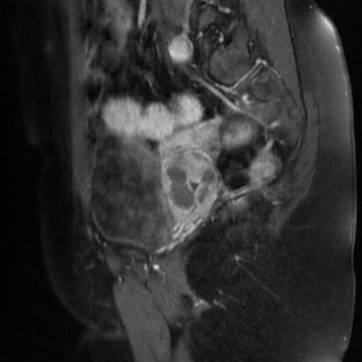 File:Adenoma malignum of cervix (Radiopaedia 66441-75705 Sagittal T1 C+ fat sat 16).jpg