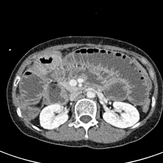 File:Adhesional small bowel obstruction (Radiopaedia 48397-53305 Axial C+ portal venous phase 27).jpg