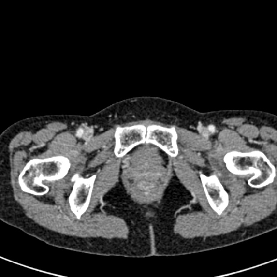 File:Adhesional small bowel obstruction (Radiopaedia 48397-53305 Axial C+ portal venous phase 95).jpg