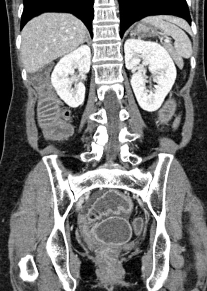 Adhesional small bowel obstruction (Radiopaedia 48397-53305 Coronal C+ portal venous phase 240).jpg