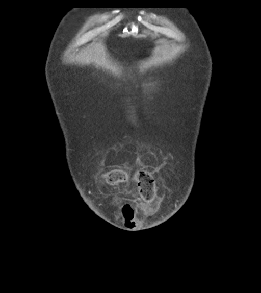 Adhesions within abdominal wall hernia (Radiopaedia 58283-65394 Coronal C+ portal venous phase 9).png