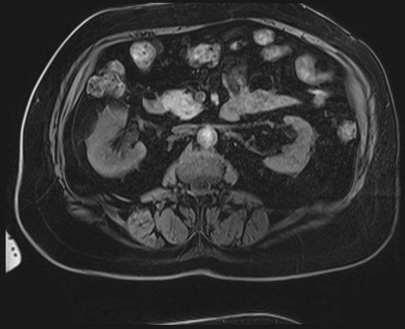 Adrenal cortical carcinoma (Radiopaedia 64017-72770 Axial T1 C+ fat sat 24).jpg