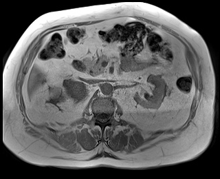 File:Adrenal cortical carcinoma (Radiopaedia 64017-72770 Axial T1 in-phase 37).jpg