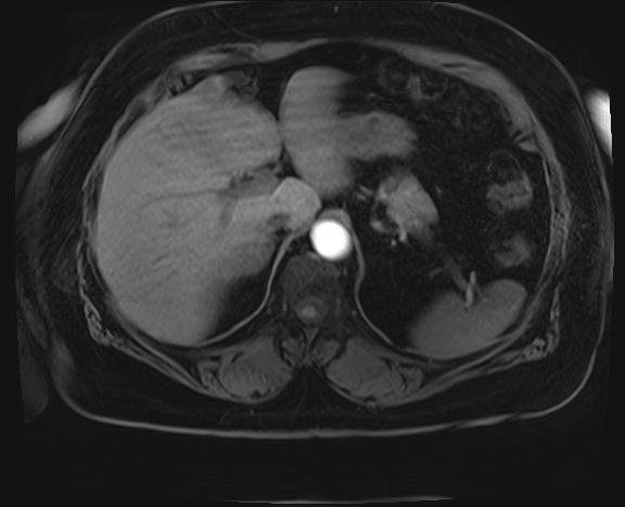 Adrenal cortical carcinoma (Radiopaedia 64017-72770 H 2).jpg