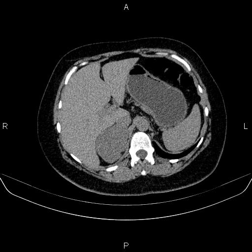 File:Adrenal cortical carcinoma (Radiopaedia 84882-100379 Axial non-contrast 22).jpg