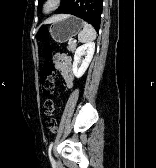 Adrenal cortical carcinoma (Radiopaedia 84882-100379 Sagittal C+ portal venous phase 65).jpg