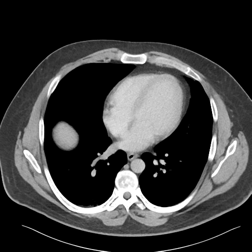 File:Adrenal cyst (Radiopaedia 45625-49777 Axial C+ portal venous phase 7).png