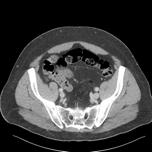 Adrenal cyst (Radiopaedia 45625-49777 Axial C+ portal venous phase 80).png