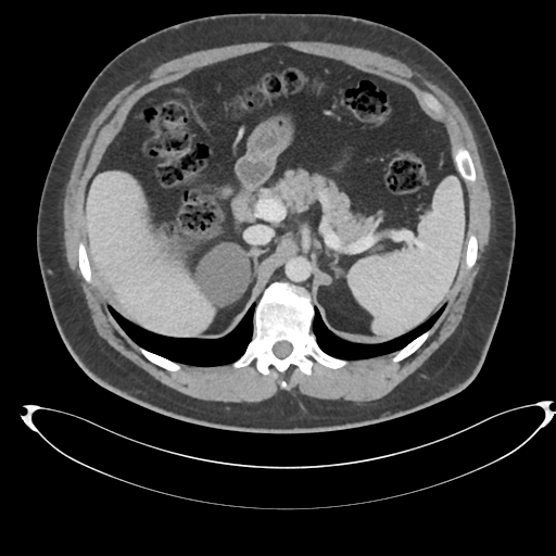 File:Adrenal cyst (Radiopaedia 45625-49778 AXIAL THICK 60 sec 18).png