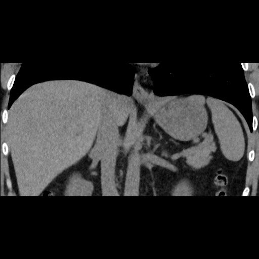 Adrenal gland trauma (Radiopaedia 81351-95079 Coronal non-contrast 49).jpg