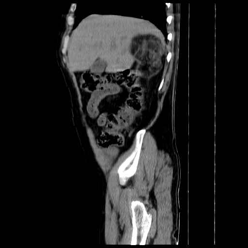 File:Adrenal myelolipoma (Radiopaedia 41843-44834 Sagittal non-contrast 3).jpg