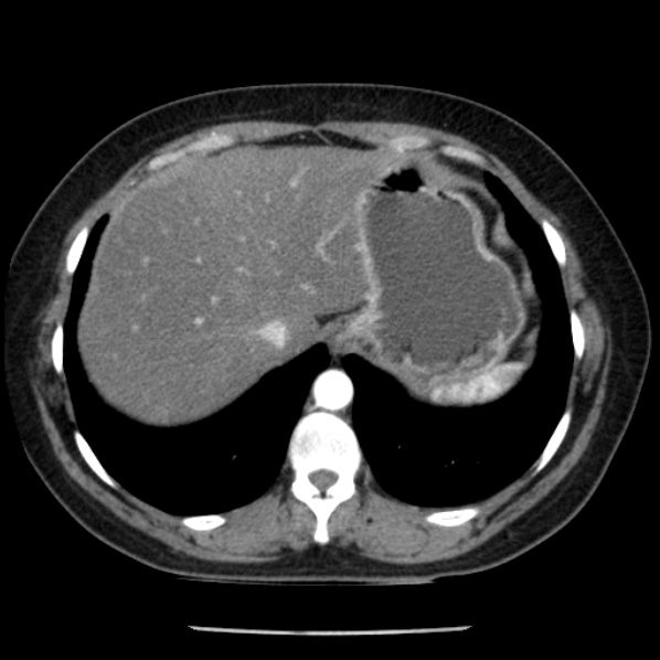 Adrenal myelolipoma (Radiopaedia 43401-46759 Axial C+ arterial phase 13).jpg