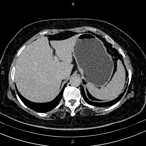 Adrenal myelolipoma (Radiopaedia 82742-96986 Axial renal excretory phase 23).jpg