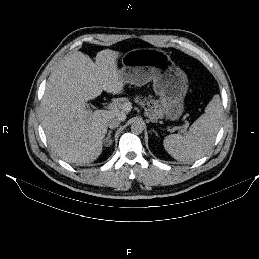 Adrenal myelolipoma (Radiopaedia 84321-99619 Axial non-contrast 29).jpg