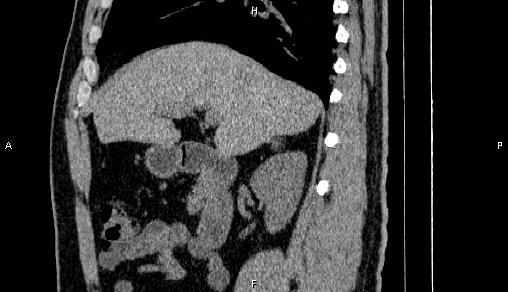 File:Adrenal myelolipoma (Radiopaedia 84321-99619 Sagittal non-contrast 39).jpg
