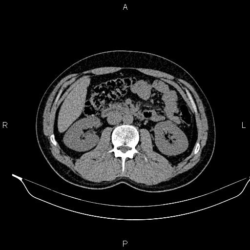 Adrenal myelolipoma (Radiopaedia 87794-104246 Axial non-contrast 48).jpg