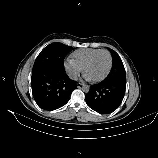 Adrenal myelolipoma (Radiopaedia 87794-104246 Axial non-contrast 5).jpg