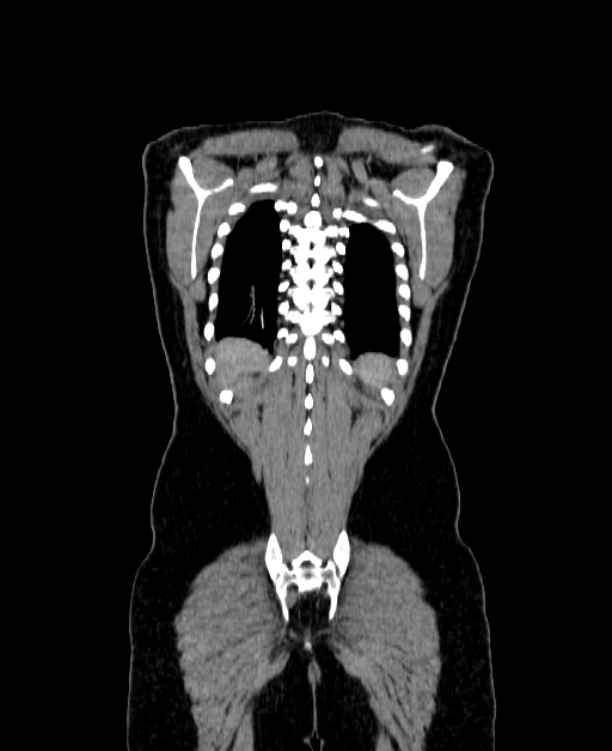 Adrenocortical carcinoma (Radiopaedia 80134-93438 Coronal C+ portal venous phase 144).jpg