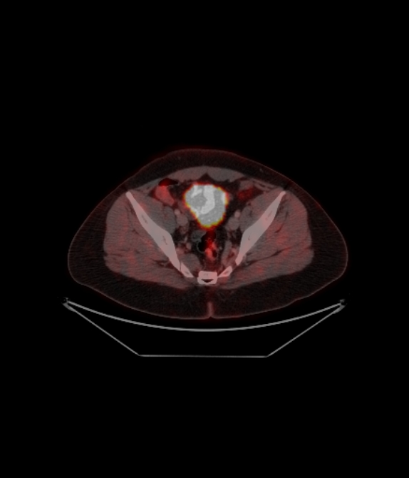 Adrenocortical carcinoma (Radiopaedia 80134-93440 ِAxial 232).jpg