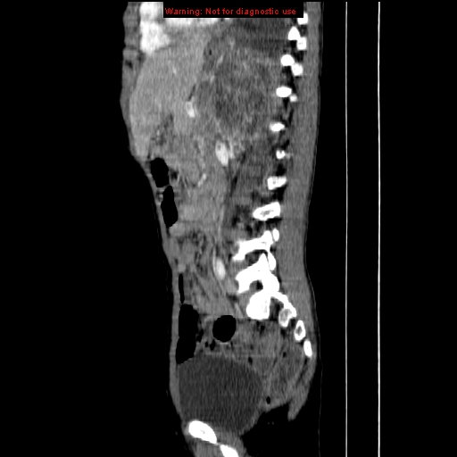 File:Adrenocortical carcinoma (Radiopaedia 9449-10131 Sagittal C+ portal venous phase 9).jpg